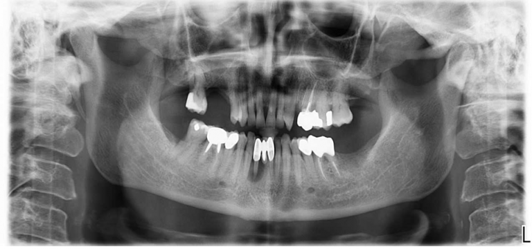 Socket Augmentation - Shefa Bone