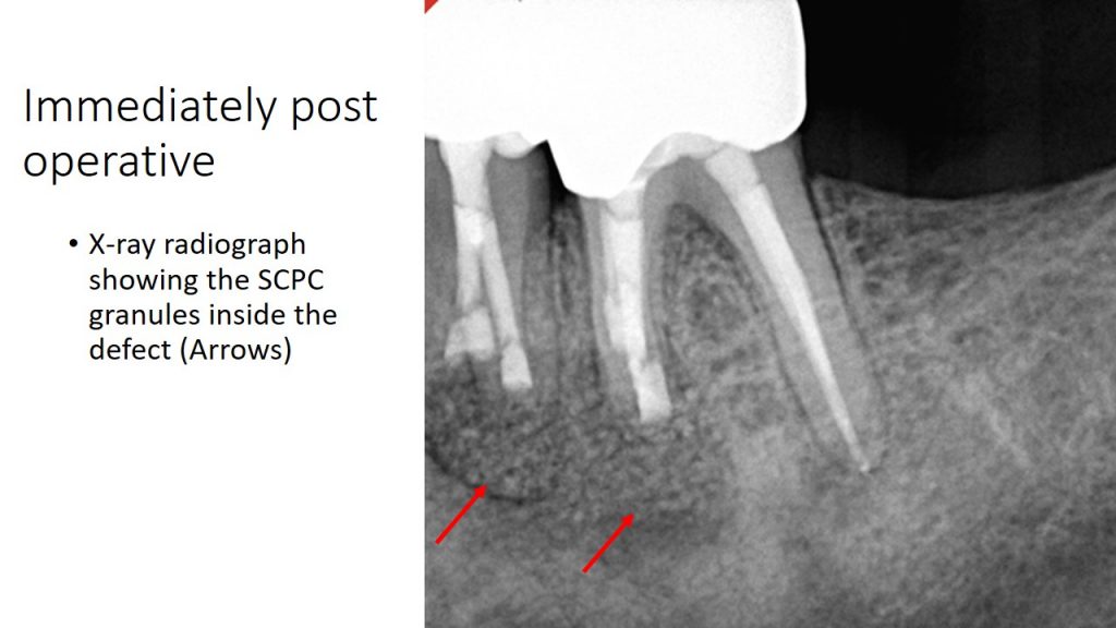 EndodonticsCase2 Shefa Bone