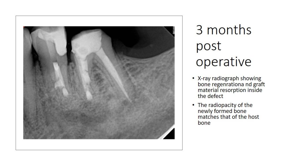 EndodonticsCase2Slide3 Shefa Bone